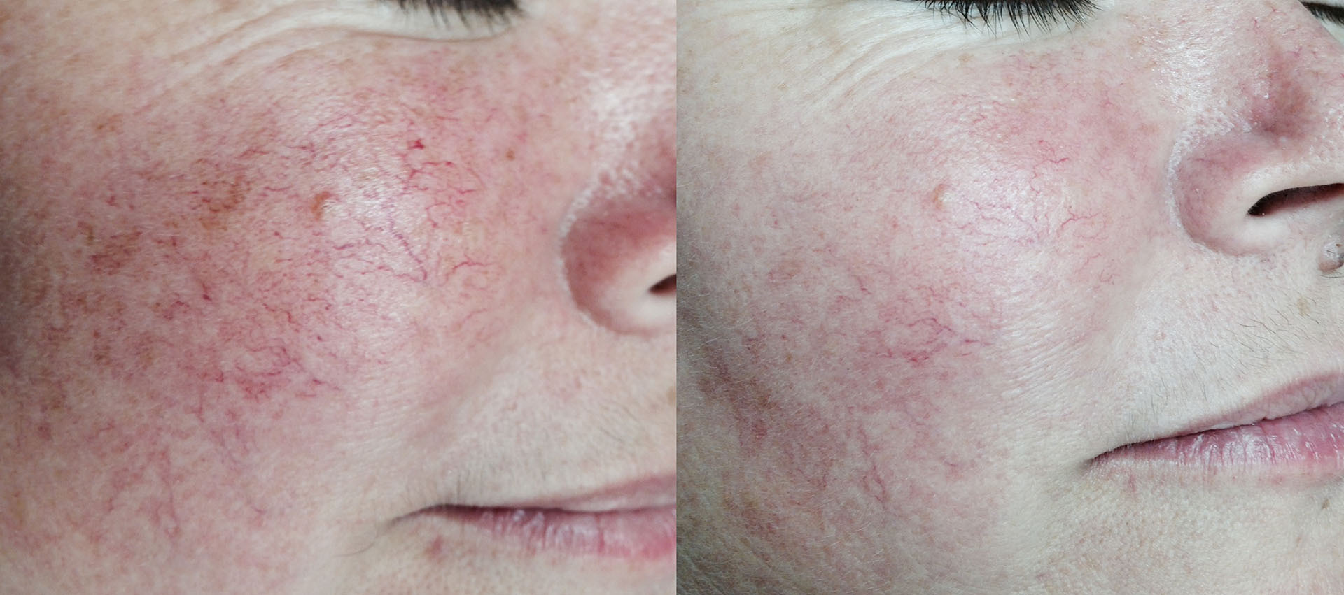 Before and after close-up on cheeks