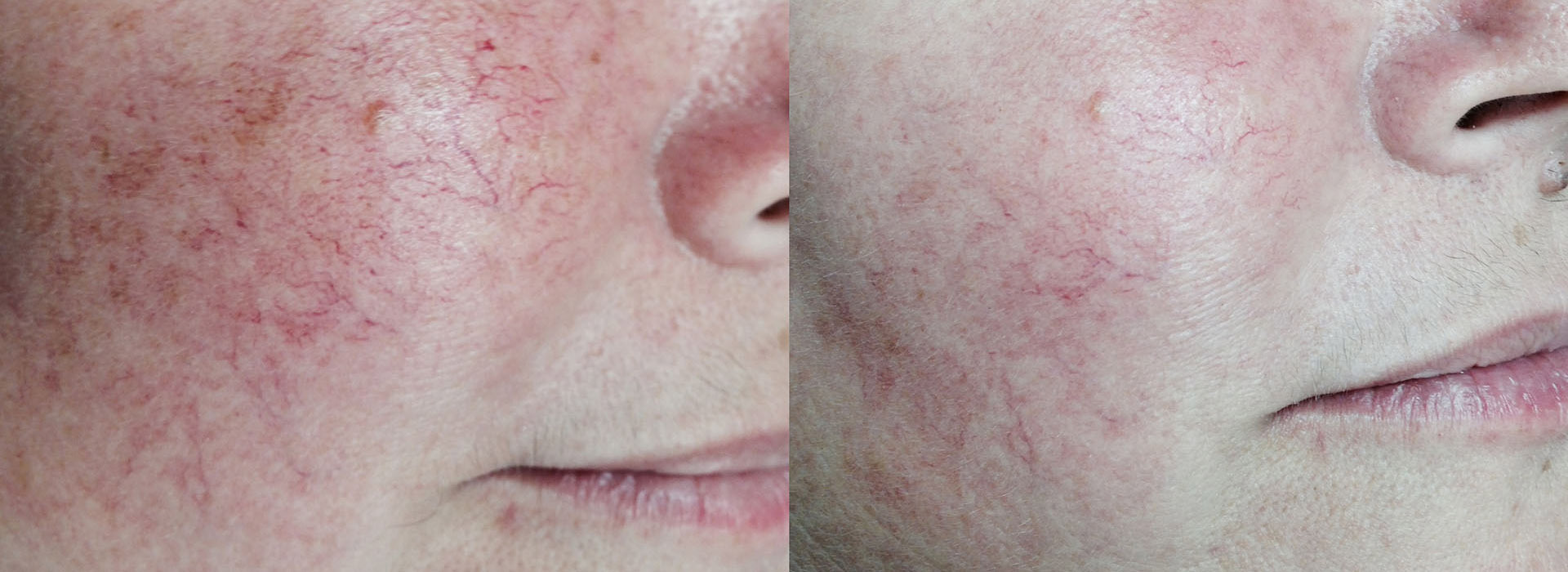 Vascular lesions skin treatment before and after results image
