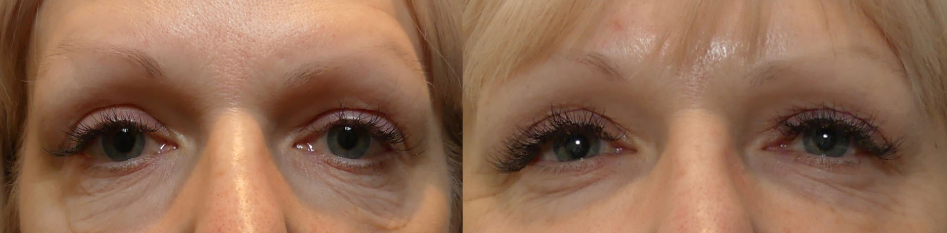 Before and after close-up on eyes