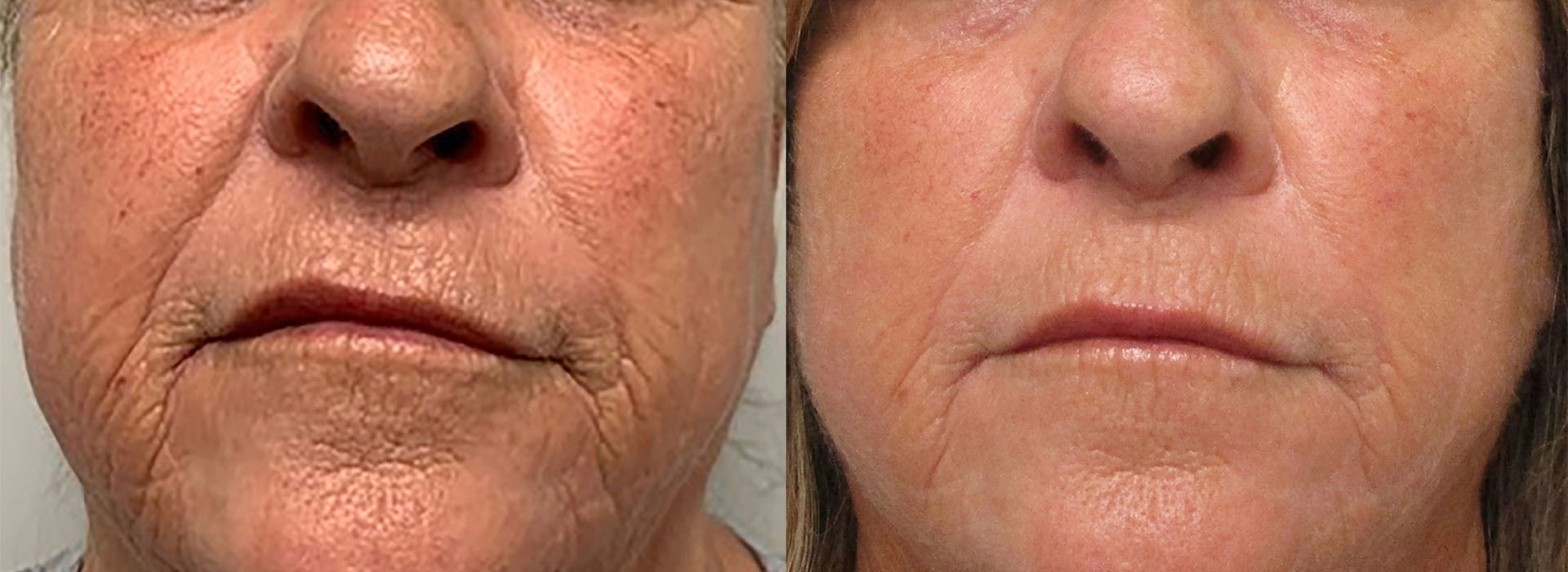 Anti-aging treatment before and after face