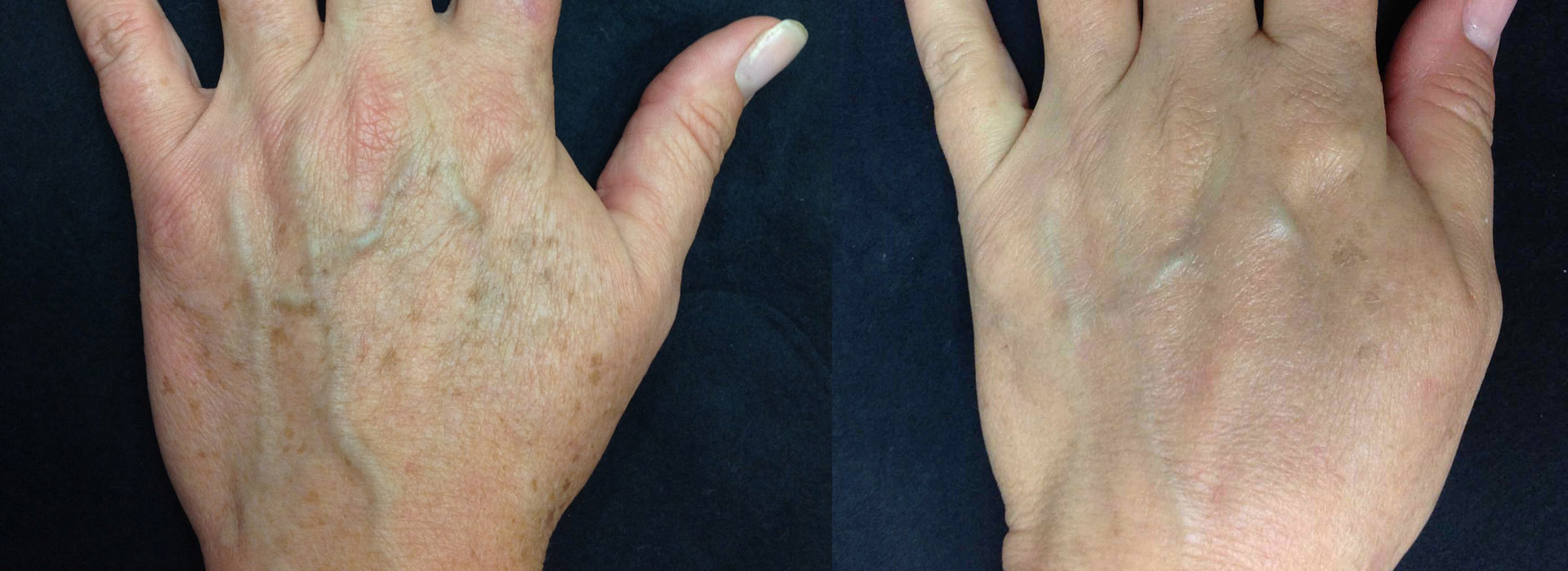 Hand skin rejuvenation before and after results image