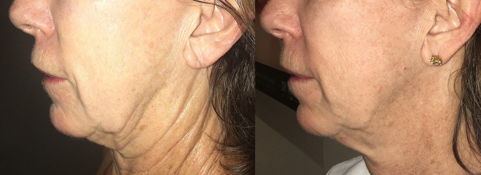 Skin tightening before and after results image