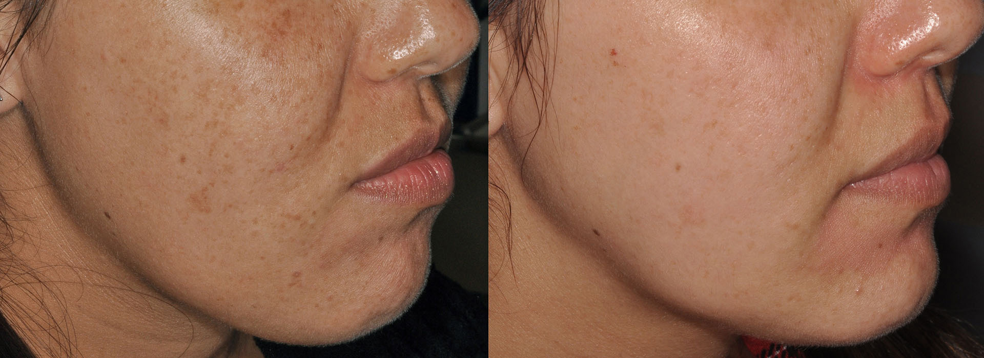 Acne scarring skin treatment before and after results image