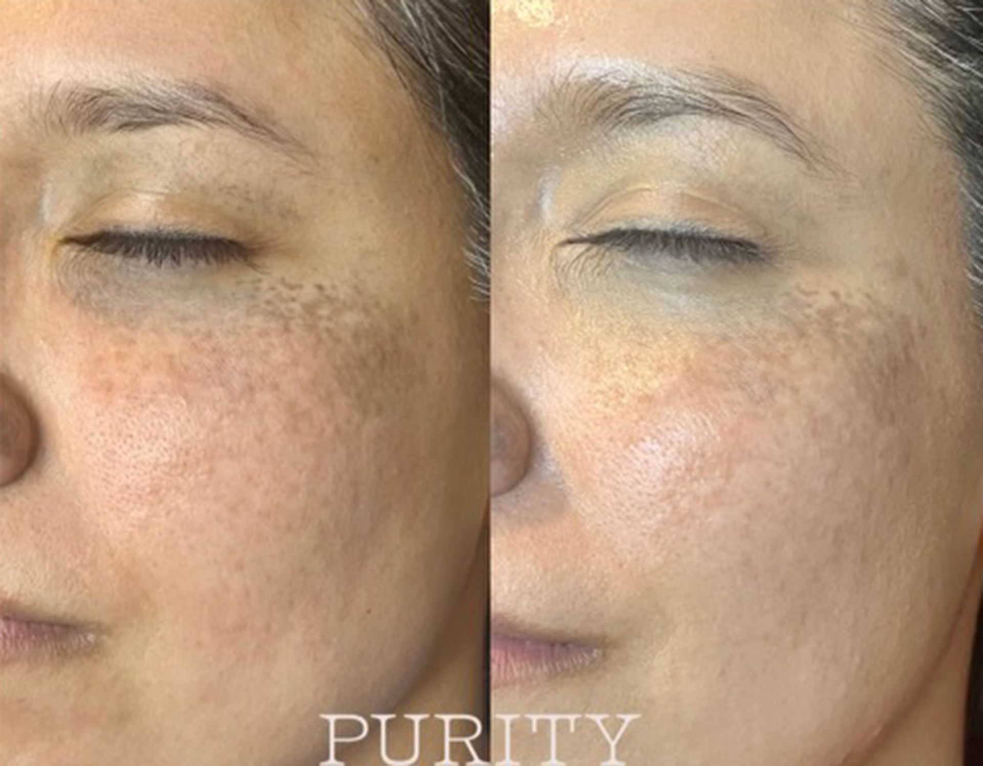 Skin pigmentation treatment before and after results image