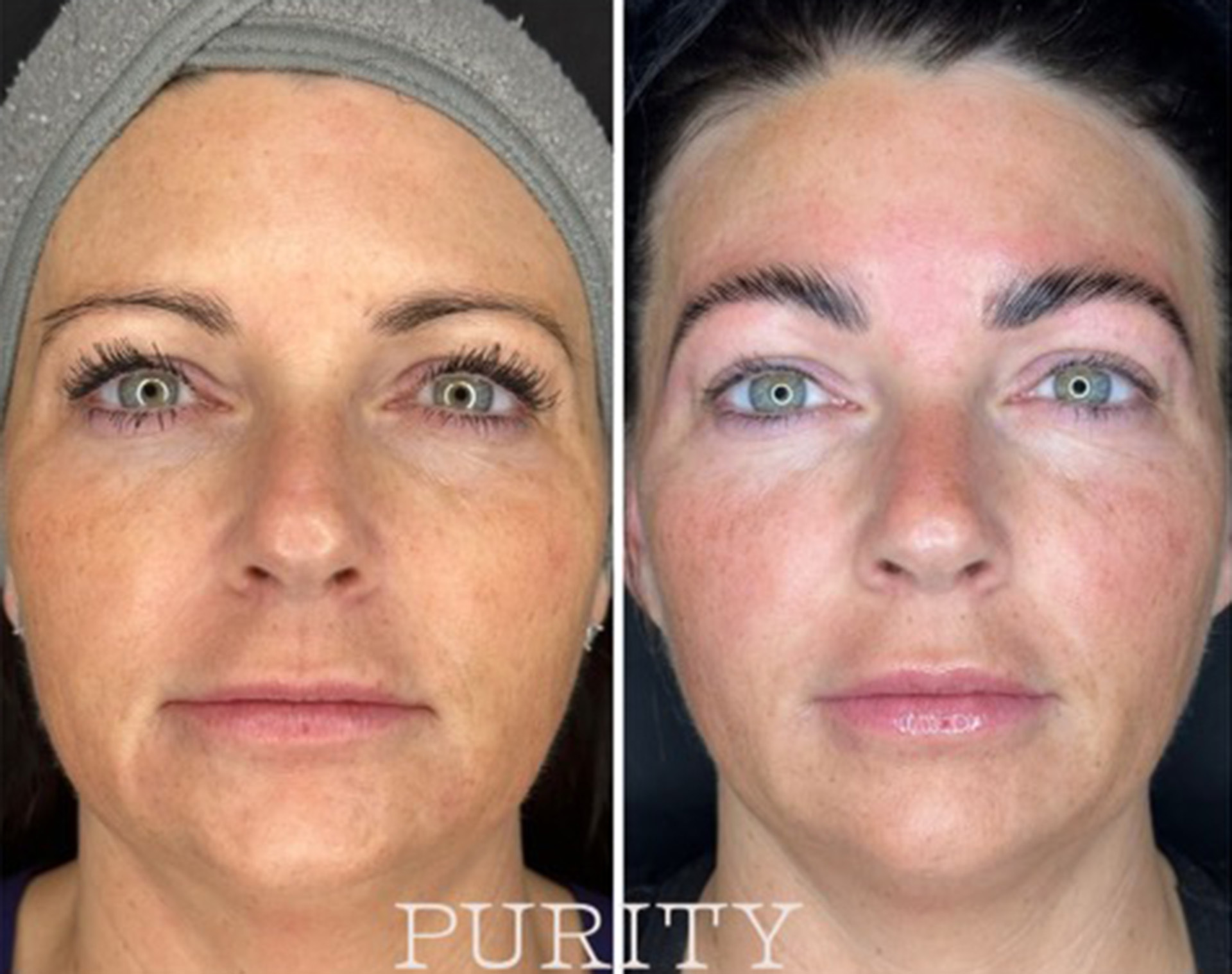Skin treatment before and after results image